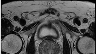 Case study 3: Deep Resolve Boost in prostate imaging on Siemens Sola (XA51)