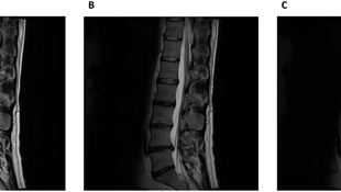 Case study 4: Deep Resolve Boost in lumbar spine imaging on Siemens Sola (XA51)
