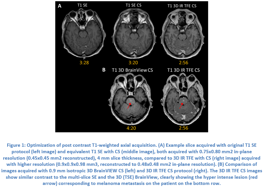Case Study 2: Compressed SENSE in brain imaging on Philips Ingenia 1.5T (RA5.4)