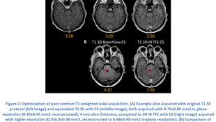 Case Study 2: Compressed SENSE in brain imaging on Philips Ingenia 1.5T (RA5.4)